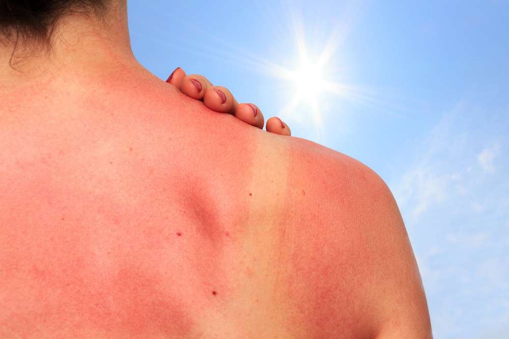Чек-лист: что делать, если кожа обгорела на солнце